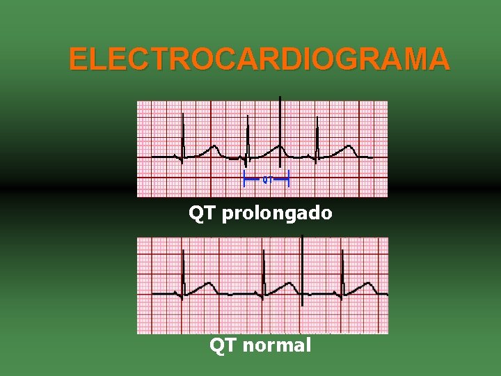 ELECTROCARDIOGRAMA QT prolongado QT normal 