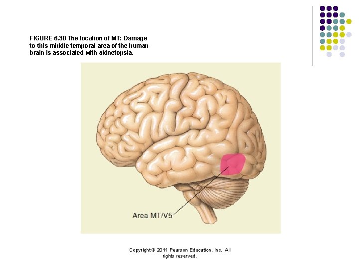FIGURE 6. 30 The location of MT: Damage to this middle temporal area of