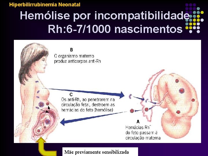 Hiperbilirrubinemia Neonatal Hemólise por incompatibilidade Rh: 6 -7/1000 nascimentos Mãe previamente sensibilizada 