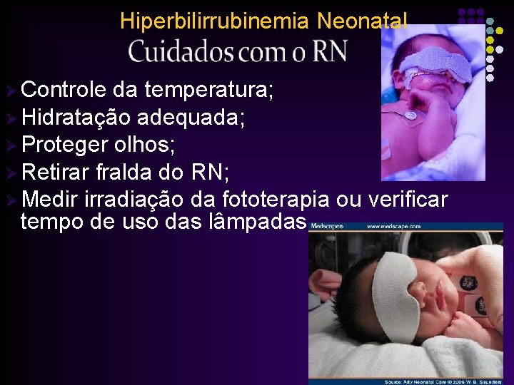 Hiperbilirrubinemia Neonatal Ø Controle da temperatura; Ø Hidratação adequada; Ø Proteger olhos; Ø Retirar