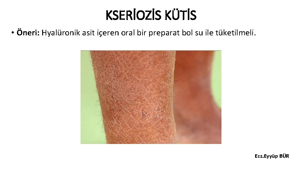 KSERİOZİS KÜTİS • Öneri: Hyalüronik asit içeren oral bir preparat bol su ile tüketilmeli.