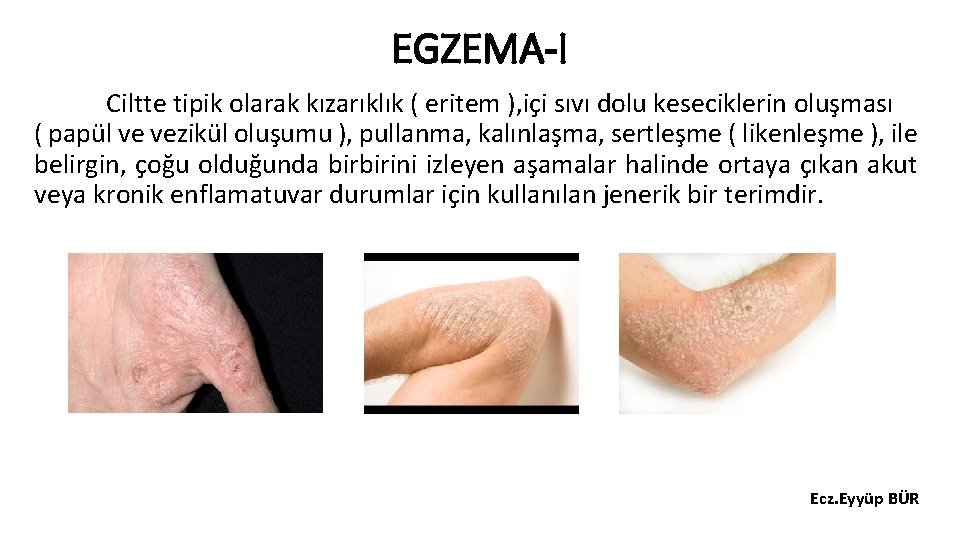 EGZEMA-I Ciltte tipik olarak kızarıklık ( eritem ), içi sıvı dolu keseciklerin oluşması (