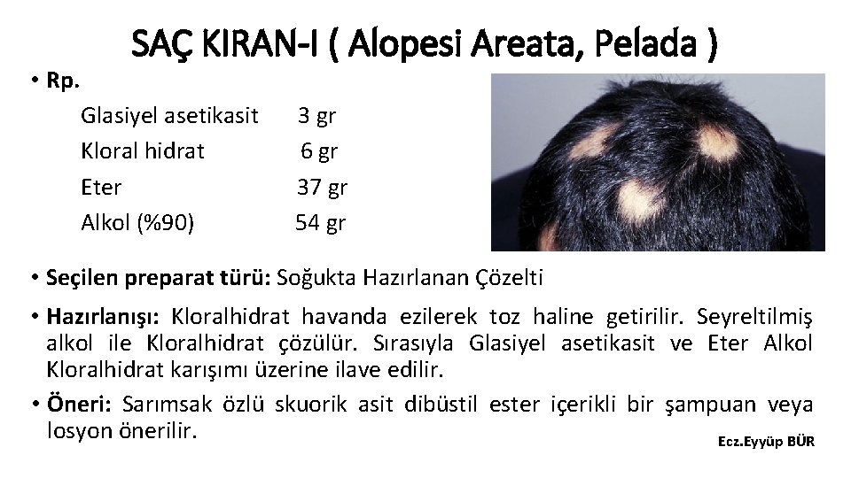  • Rp. SAÇ KIRAN-I ( Alopesi Areata, Pelada ) Glasiyel asetikasit Kloral hidrat
