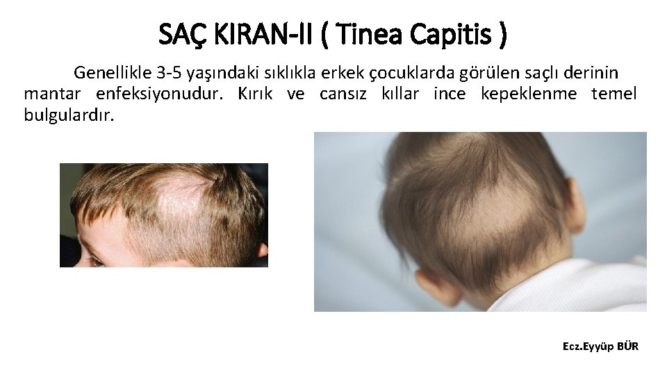 SAÇ KIRAN-II ( Tinea Capitis ) Genellikle 3 -5 yaşındaki sıklıkla erkek çocuklarda görülen