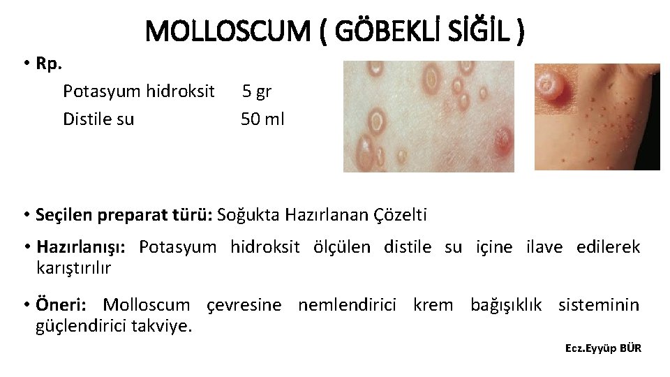 MOLLOSCUM ( GÖBEKLİ SİĞİL ) • Rp. Potasyum hidroksit Distile su 5 gr 50