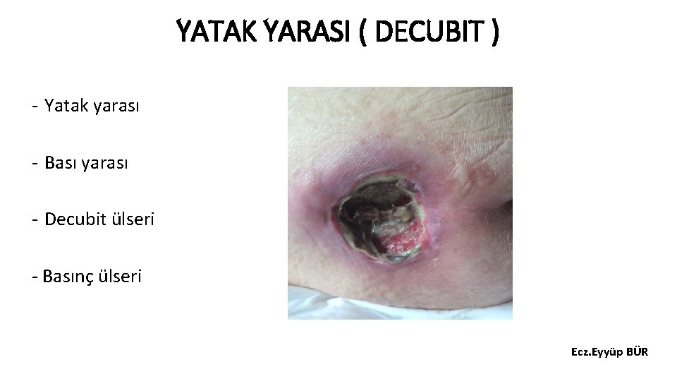 YATAK YARASI ( DECUBIT ) - Yatak yarası - Bası yarası - Decubit ülseri