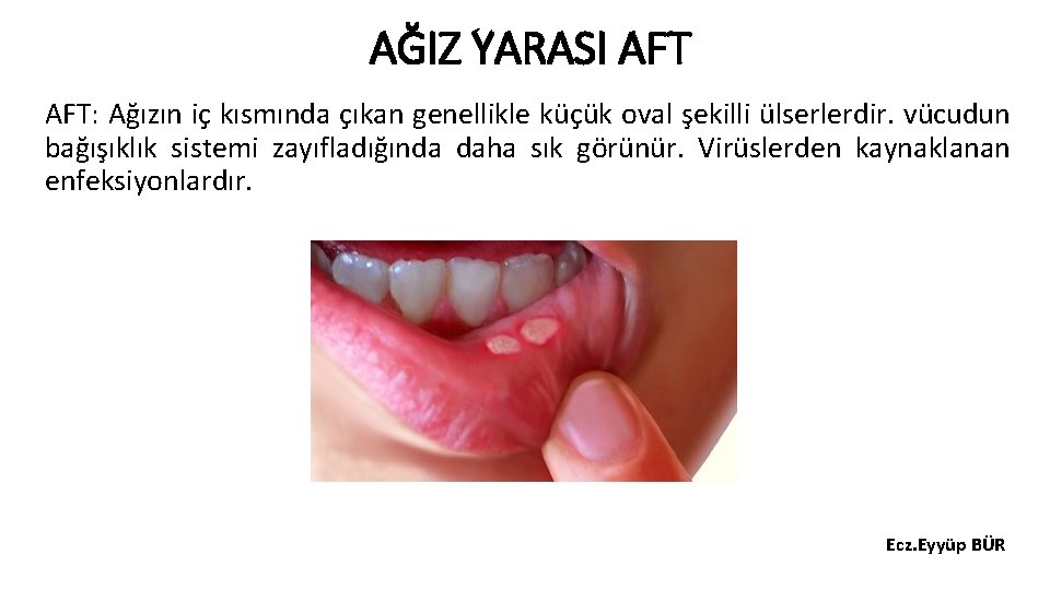 AĞIZ YARASI AFT: Ağızın iç kısmında çıkan genellikle küçük oval şekilli ülserlerdir. vücudun bağışıklık