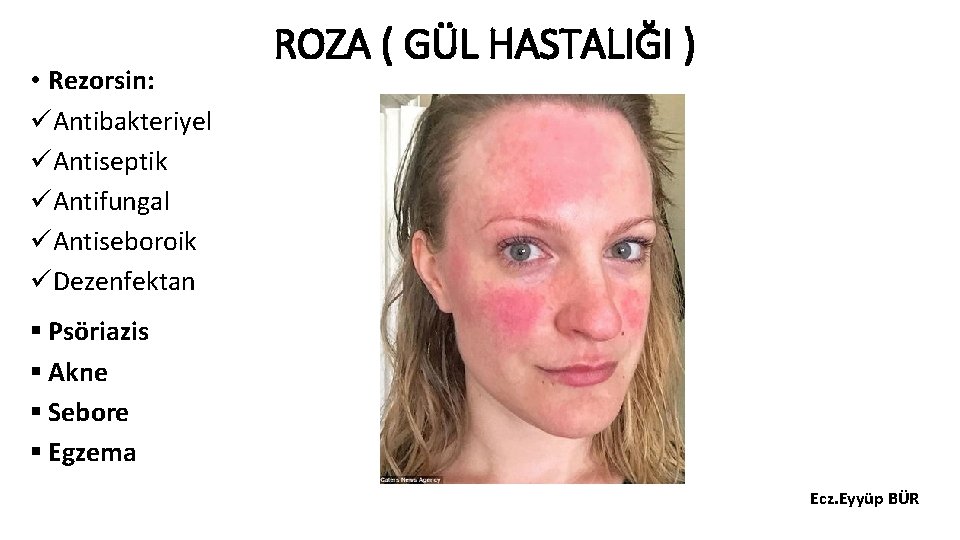  • Rezorsin: üAntibakteriyel üAntiseptik üAntifungal üAntiseboroik üDezenfektan ROZA ( GÜL HASTALIĞI ) §