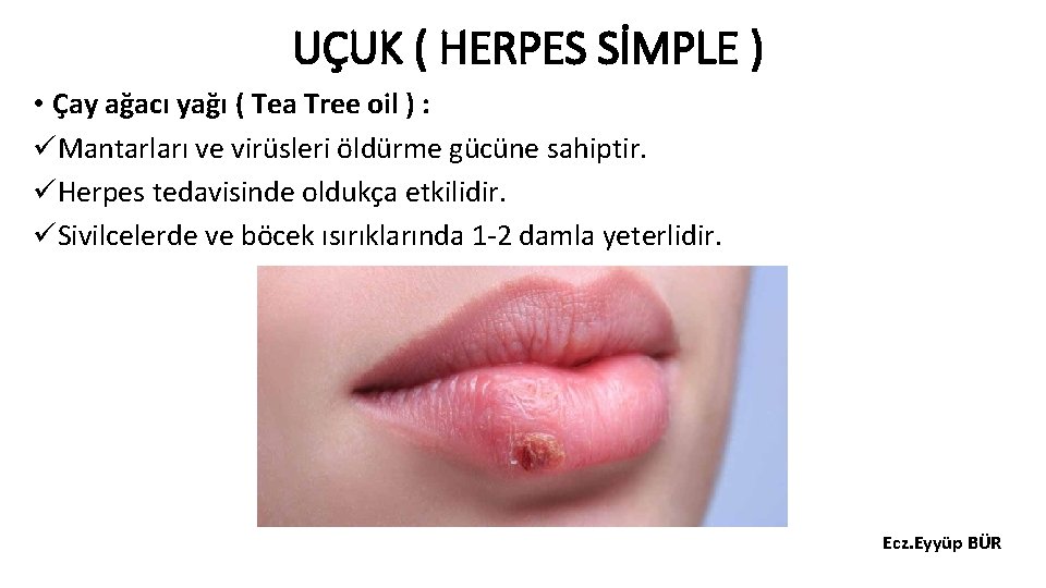 UÇUK ( HERPES SİMPLE ) • Çay ağacı yağı ( Tea Tree oil )