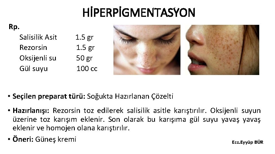 HİPERPİGMENTASYON Rp. Salisilik Asit Rezorsin Oksijenli su Gül suyu 1. 5 gr 50 gr