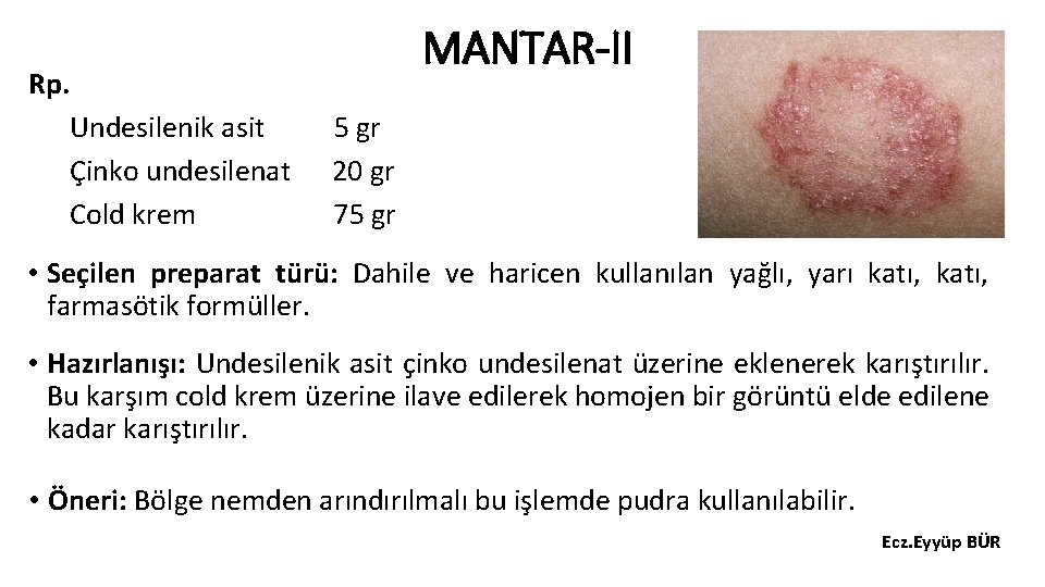 Rp. Undesilenik asit Çinko undesilenat Cold krem MANTAR-II 5 gr 20 gr 75 gr