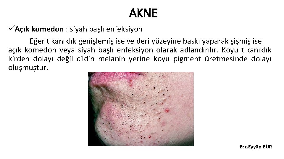 AKNE üAçık komedon : siyah başlı enfeksiyon Eğer tıkanıklık genişlemiş ise ve deri yüzeyine