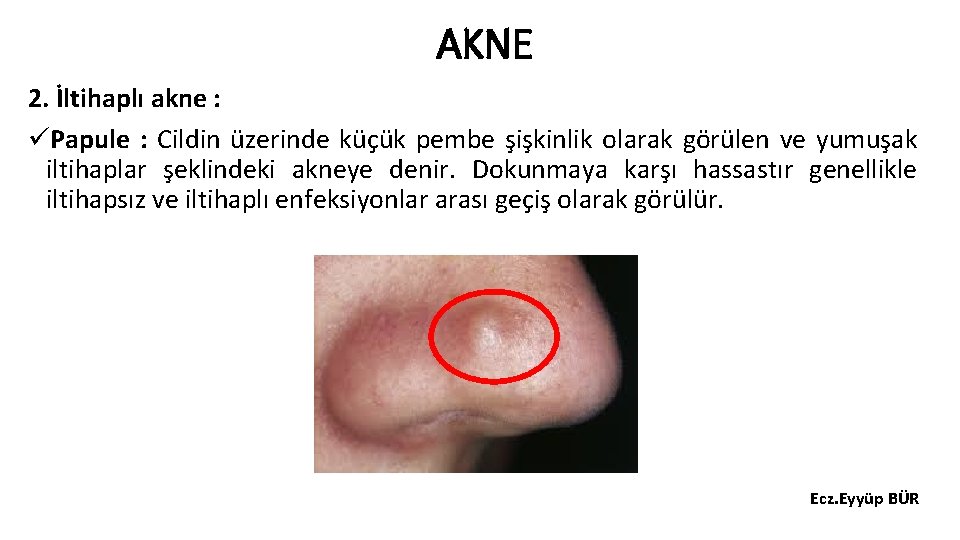 AKNE 2. İltihaplı akne : üPapule : Cildin üzerinde küçük pembe şişkinlik olarak görülen