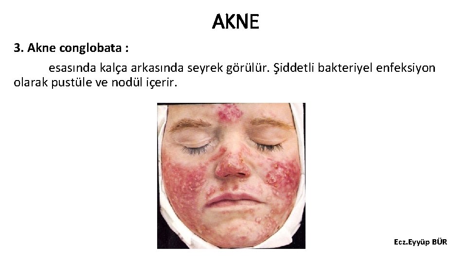 AKNE 3. Akne conglobata : esasında kalça arkasında seyrek görülür. Şiddetli bakteriyel enfeksiyon olarak