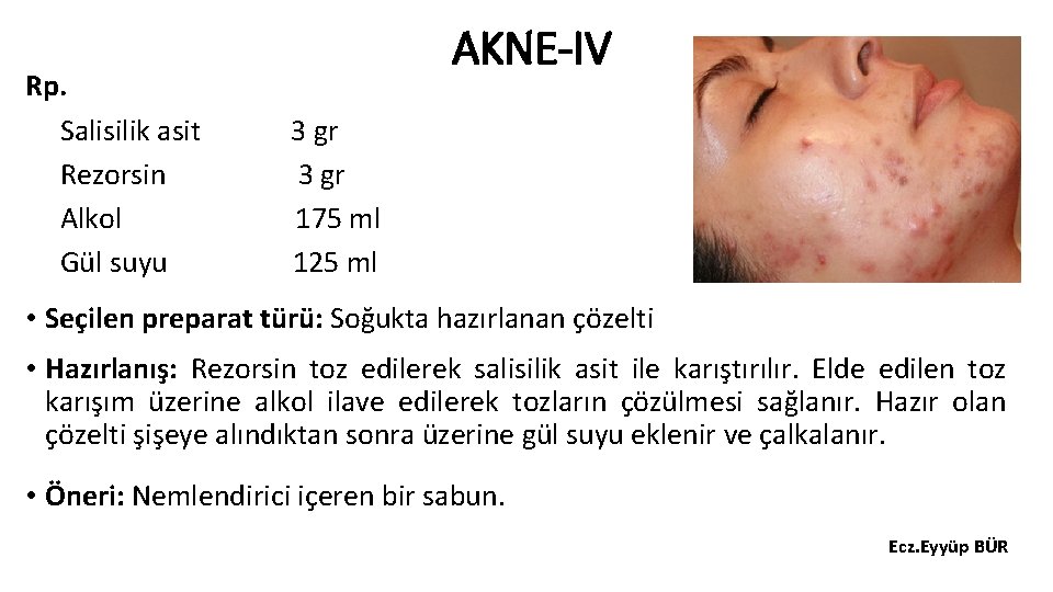 Rp. Salisilik asit Rezorsin Alkol Gül suyu AKNE-IV 3 gr 175 ml 125 ml