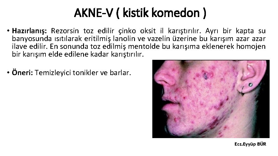 AKNE-V ( kistik komedon ) • Hazırlanış: Rezorsin toz edilir çinko oksit il karıştırılır.