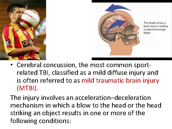  • Cerebral concussion, the most common sportrelated TBI, classified as a mild diffuse