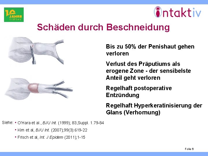 Schäden durch Beschneidung Bis zu 50% der Penishaut gehen verloren Verlust des Präputiums als