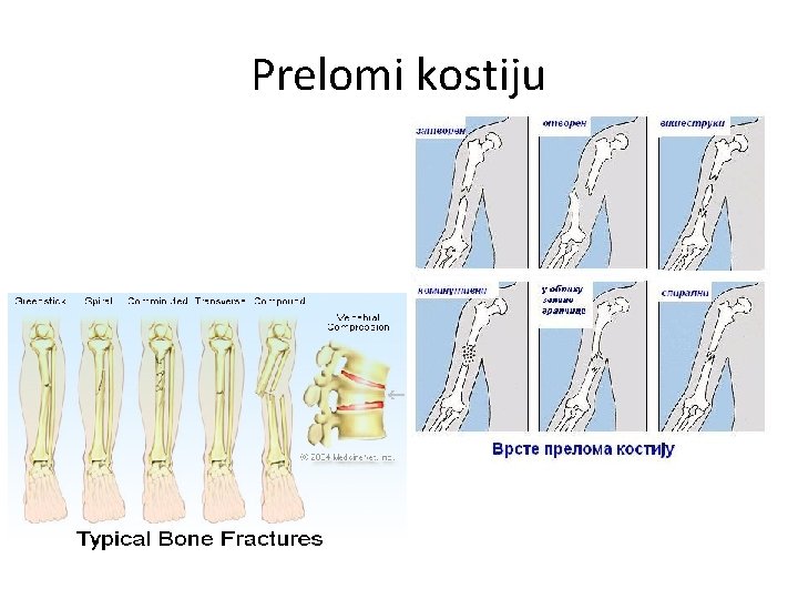 Prelomi kostiju 