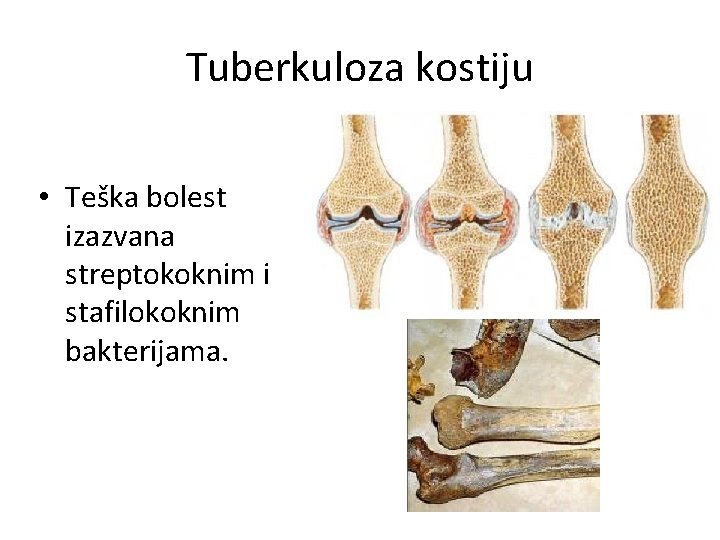 Tuberkuloza kostiju • Teška bolest izazvana streptokoknim i stafilokoknim bakterijama. 