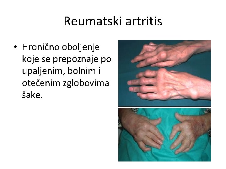 Reumatski artritis • Hronično oboljenje koje se prepoznaje po upaljenim, bolnim i otečenim zglobovima