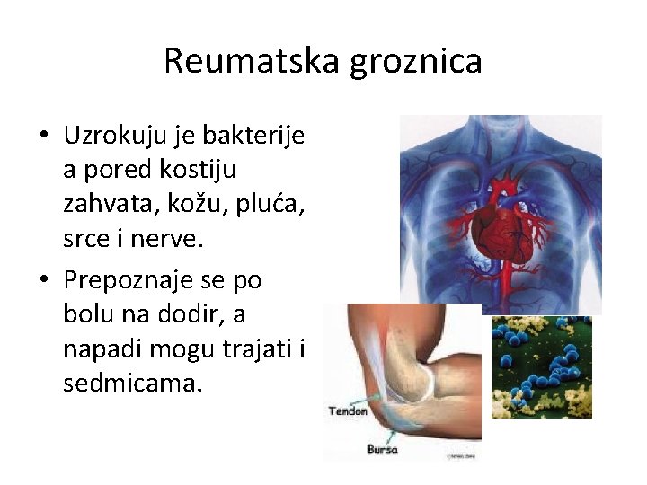 Reumatska groznica • Uzrokuju je bakterije a pored kostiju zahvata, kožu, pluća, srce i