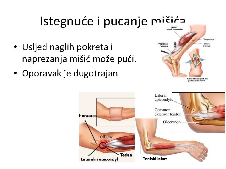 Istegnuće i pucanje mišića • Usljed naglih pokreta i naprezanja mišić može pući. •