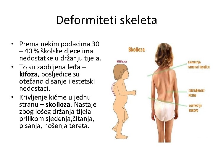 Deformiteti skeleta • Prema nekim podacima 30 – 40 % školske djece ima nedostatke