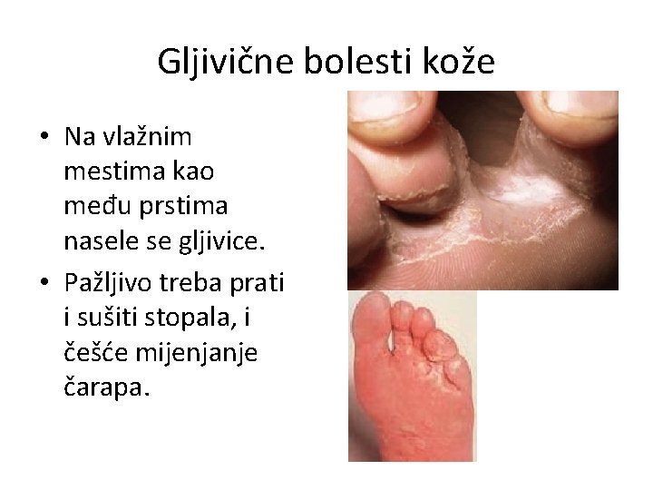 Gljivične bolesti kože • Na vlažnim mestima kao među prstima nasele se gljivice. •