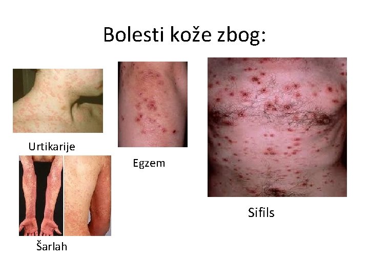 Bolesti kože zbog: Urtikarije Egzem Sifils Šarlah 