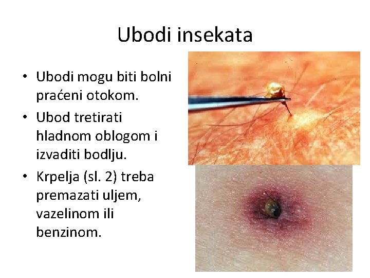 Ubodi insekata • Ubodi mogu biti bolni praćeni otokom. • Ubod tretirati hladnom oblogom