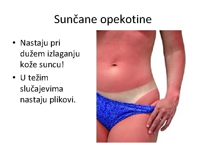 Sunčane opekotine • Nastaju pri dužem izlaganju kože suncu! • U težim slučajevima nastaju