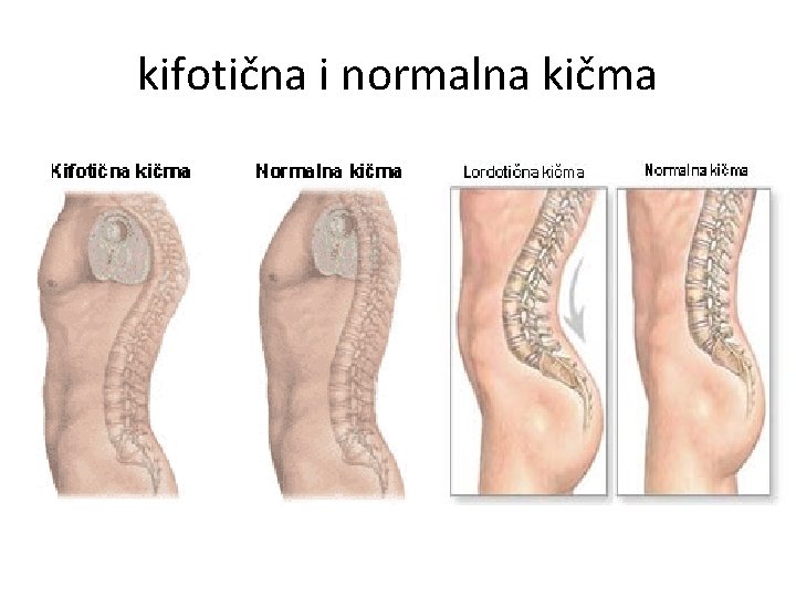 kifotična i normalna kičma 