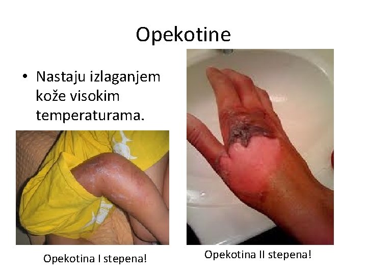 Opekotine • Nastaju izlaganjem kože visokim temperaturama. Opekotina I stepena! Opekotina II stepena! 