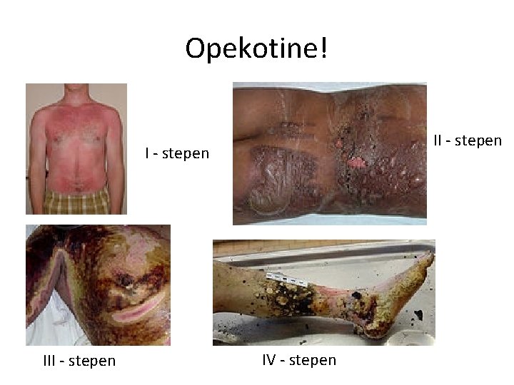 Opekotine! II - stepen III - stepen IV - stepen 