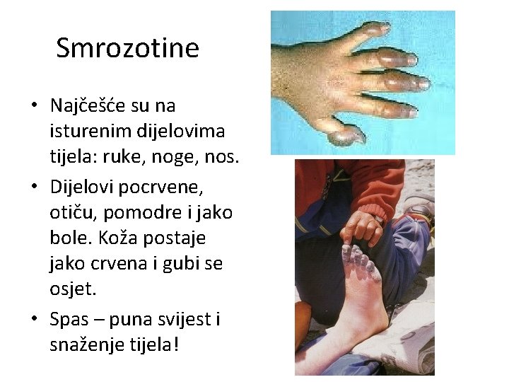 Smrozotine • Najčešće su na isturenim dijelovima tijela: ruke, noge, nos. • Dijelovi pocrvene,