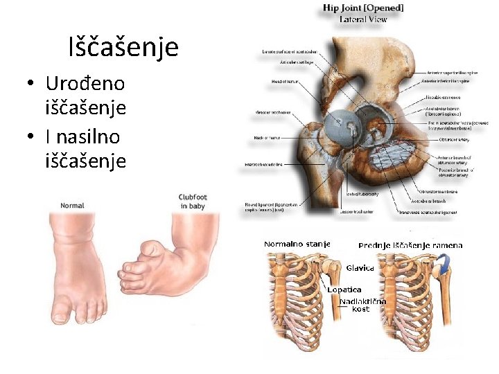 Iščašenje • Urođeno iščašenje • I nasilno iščašenje 