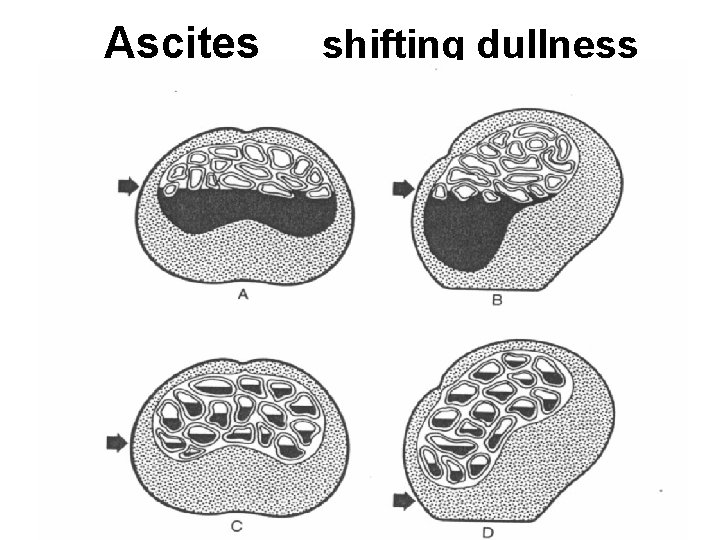 Ascites shifting dullness 