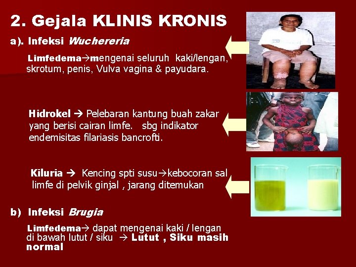 2. Gejala KLINIS KRONIS a). Infeksi Wuchereria Limfedema mengenai seluruh kaki/lengan, skrotum, penis, Vulva