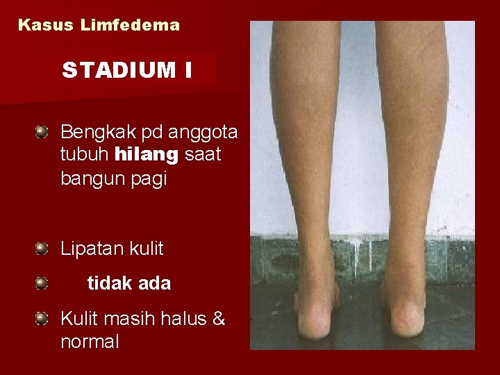 Kasus Limfedema STADIUM I Bengkak pd anggota tubuh hilang saat bangun pagi Lipatan kulit