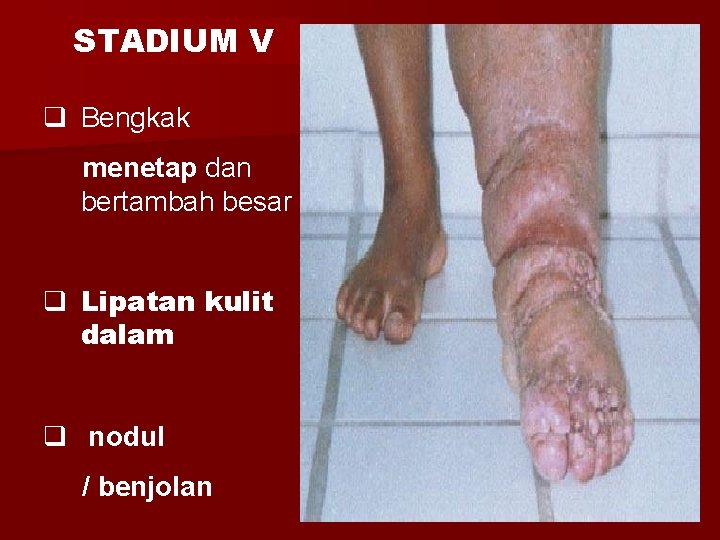 STADIUM V q Bengkak menetap dan bertambah besar q Lipatan kulit dalam q nodul