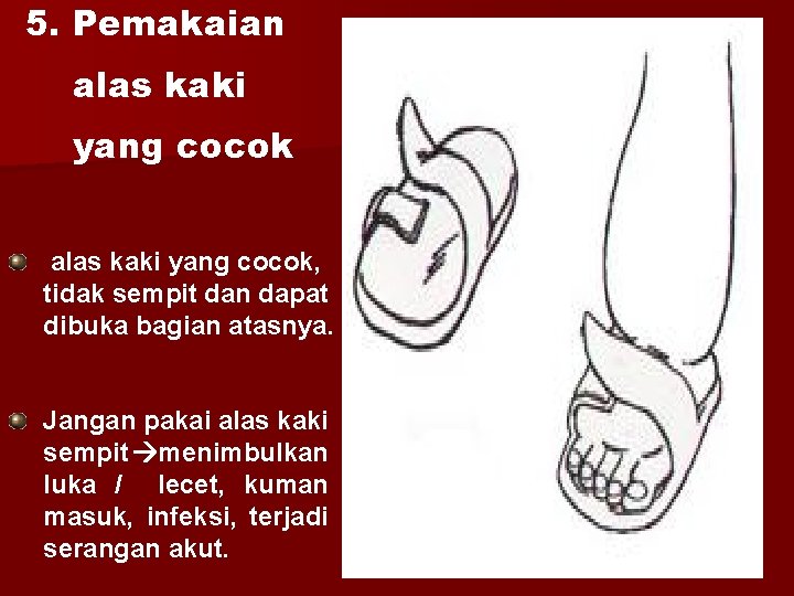 5. Pemakaian alas kaki yang cocok, tidak sempit dan dapat dibuka bagian atasnya. Jangan