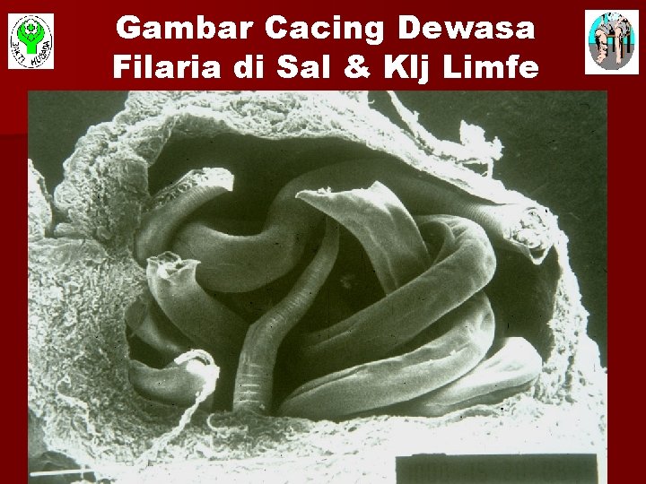 Gambar Cacing Dewasa Filaria di Sal & Klj Limfe 