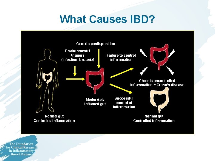 What Causes IBD? Genetic predisposition Environmental triggers (infection, bacteria) Failure to control inflammation Chronic