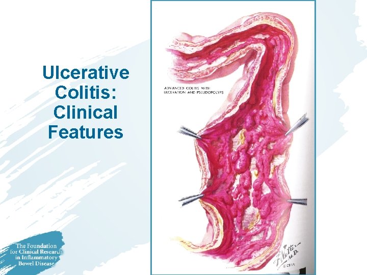 Ulcerative Colitis: Clinical Features Ulcerative Colitis: Clinical Features