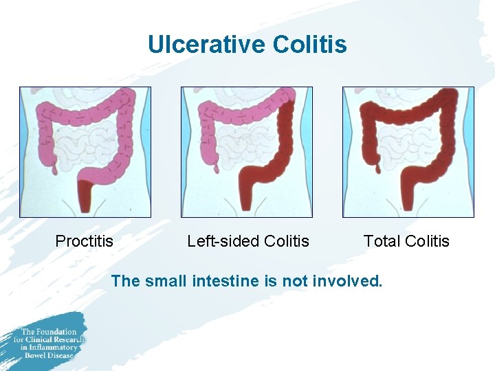 Ulcerative Colitis Proctitis Left-sided Colitis Total Colitis The small intestine is not involved. Ulcerative Colitis Proctitis Left-sided Colitis Total Colitis The small intestine is not involved.