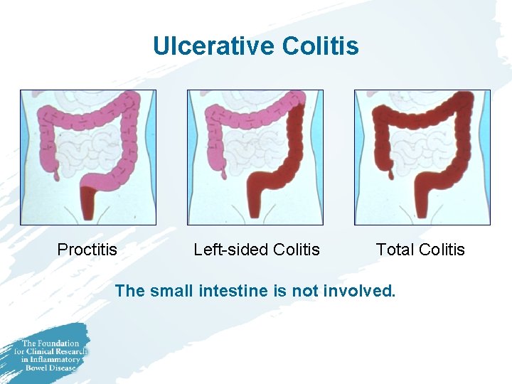 Ulcerative Colitis Proctitis Left-sided Colitis Total Colitis The small intestine is not involved. 