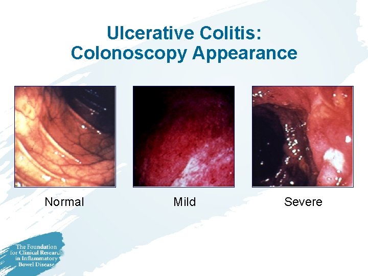 Ulcerative Colitis: Colonoscopy Appearance Normal Mild Severe 