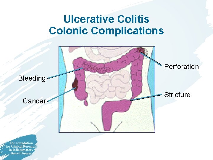 Ulcerative Colitis Colonic Complications Perforation Bleeding Cancer Stricture 