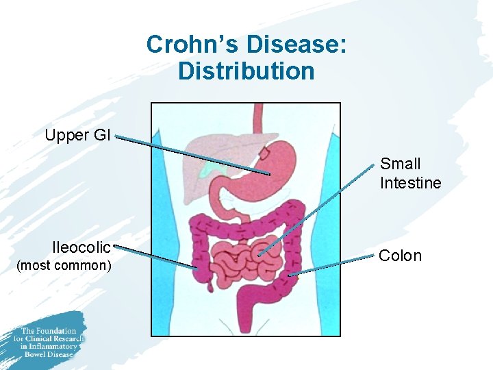 Crohn’s Disease: Distribution Upper GI Small Intestine Ileocolic (most common) Colon 